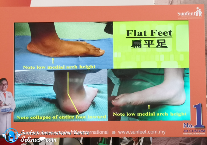 Common Foot Problems and Their Solutions