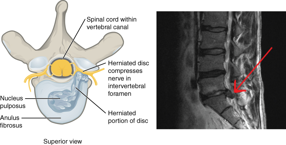 Symptoms of a Herniated Disc