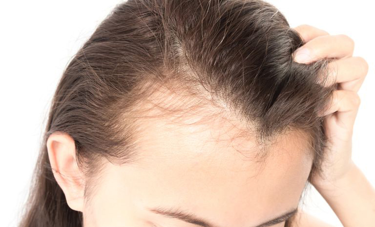 The Psychological Impact of Hair Loss
