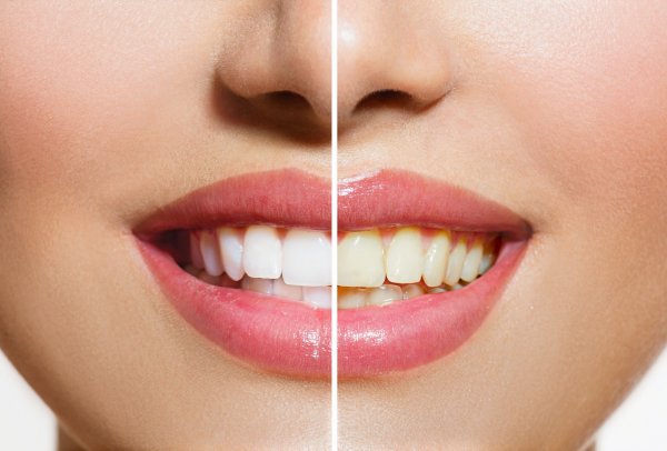 Understanding Teeth Whitening: The Science Behind a Brighter Smile