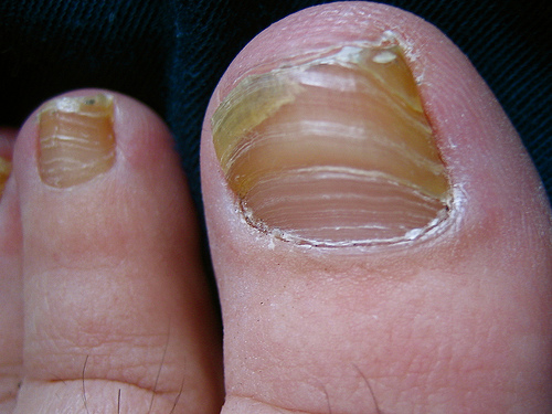 What is Nail Fungus?