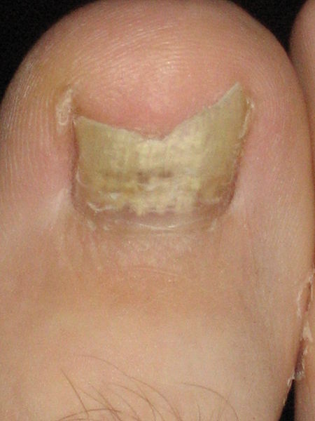 Symptoms of Nail Fungus