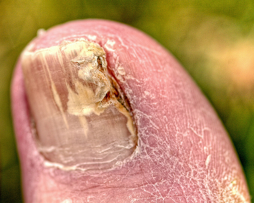 Preventing Nail Fungus: Best Practices