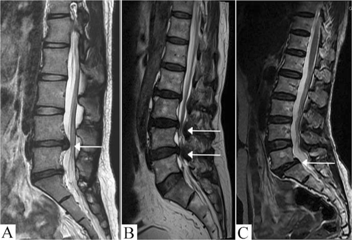 Diagnosis of Herniated Discs