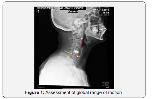Symptoms of Cervical Disc Herniation