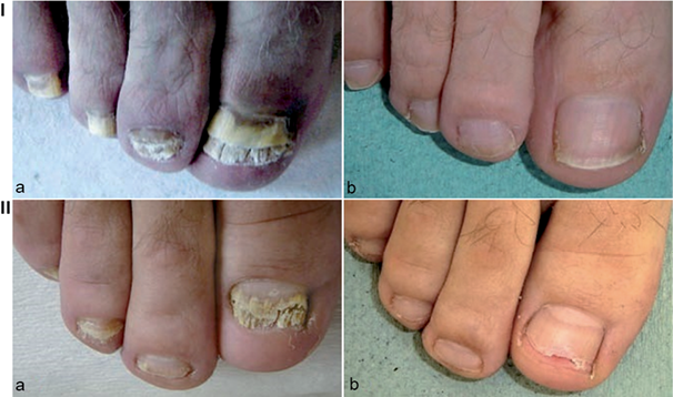 Treatment Options for Nail Fungus