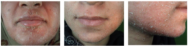 Topical Treatments: Finding What Works for You